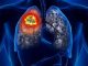 Mais de 1,5 milhão tem câncer de pulmão no mundo