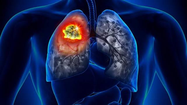 Mais de 1,5 milhão tem câncer de pulmão no mundo
