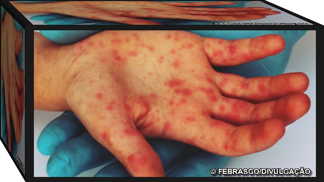 Acre investiga 8 casos de sarampo