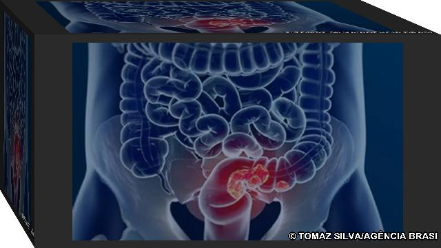 mortalidade por cancer até 2040 Estudo projeta aumento de 36% em mortes por câncer colorretal até 2040